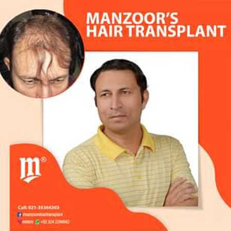Hair Restoration Cost - The Best Hair Loss Products of 2021