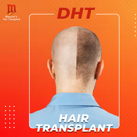 Is DHT (Direct Hair Transplantation) a good option?