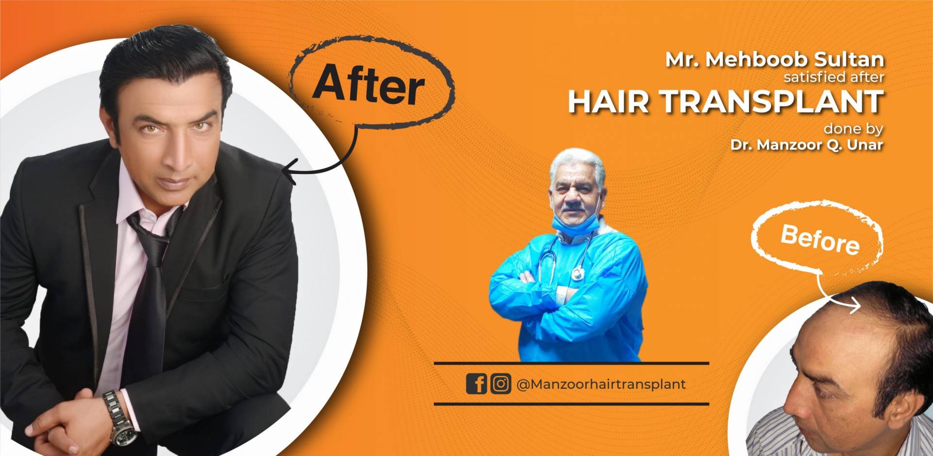 Best Hair Transplant in Karachi Clifton Manzoor Hair Transplant